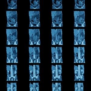 Abdomen & Pelvis CT Scan