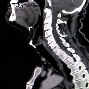 Spine CT Scan