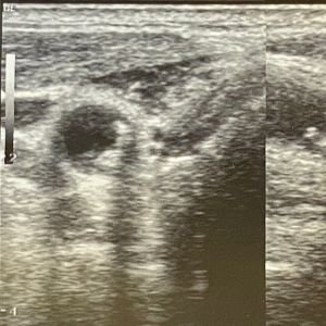 Carotid Artery Doppler