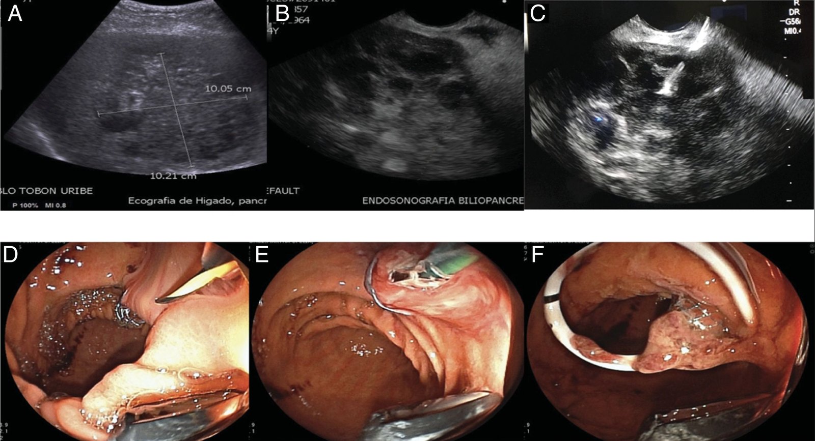 Percutaneous Interventions