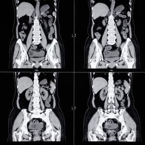 Abdominal MRI