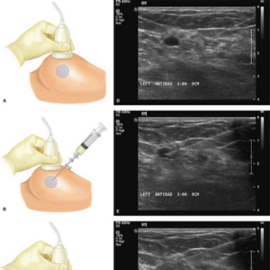 Percutaneous Drainage