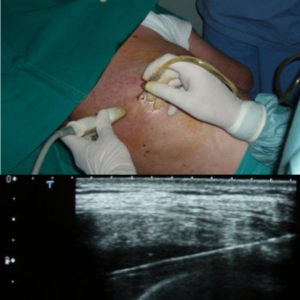 Pigtail Catheter Placement