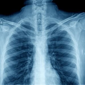 Chest X-Ray